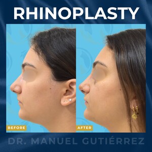 Image of Rhinoplasty