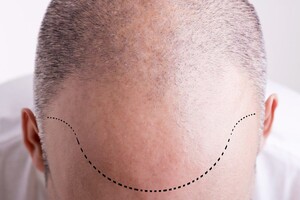 Image of Genesis Hair Transplant Gallery 1