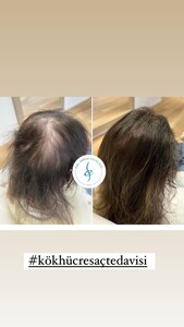 Image of Hair loss treatment