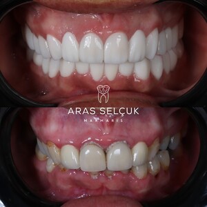 Image of Zirconium Crowns - Aras Selçuk Marmaris Dental Clinic