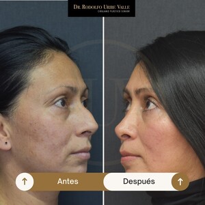 Image of Rhinoplasty