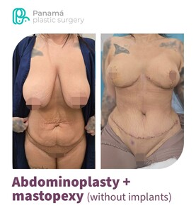 Image of Tummy tuck with breast reduction 