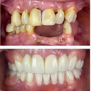 Image of Dental implants