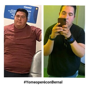 Image of Before and after gastric sleeve