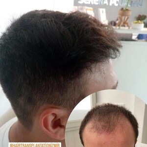 Image of Hair transplant