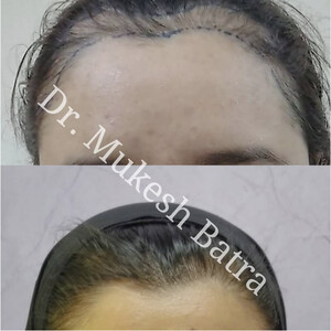 Image of Dr. Mukesh Batra Dermatologist Hair Transplant Gallery 2