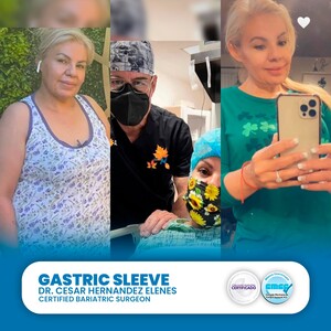 Image of Gastric sleeve