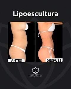 Image of Liposuction