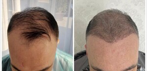 Image of Hair transplant - Ava Hair Transplant