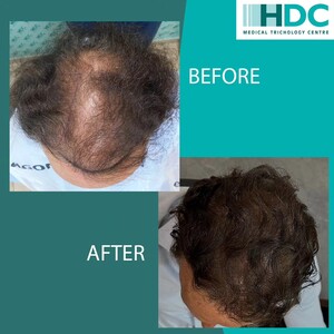 Image of HDC Hair Clinic Gallery 0