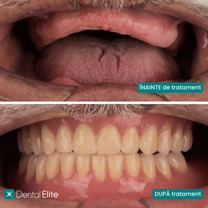 Image of Dental Implants - Dental Elite