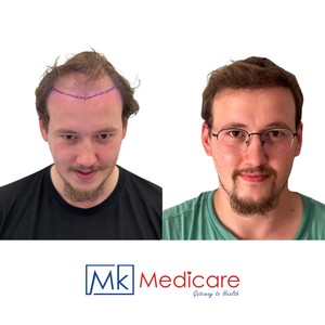 Image of Hair transplant