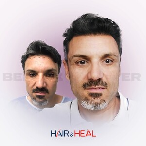 Image of Hair transplant