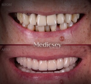 Image of Hollywood smile before and after