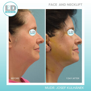 Image of Face and Neck Lift - LD Clinic Prague