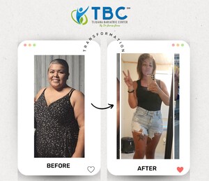 Image of Before and after bariatric surgery