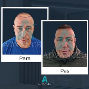 Image of Advanced Hair Transplant Gallery 1