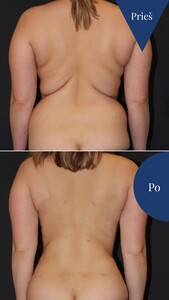 Image of Liposuction - Vitkus Clinic