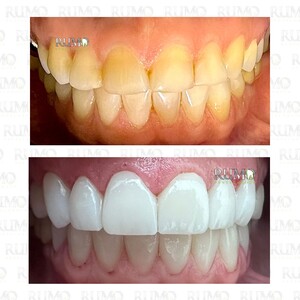 Image of Dental veneers