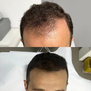 Image of Micro FUE - Arta Hair Clinic