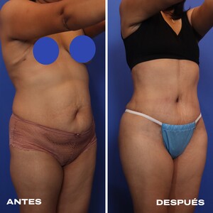 Image of Before and after tummy tuck