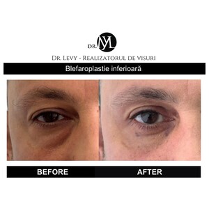 Image of Eyelift - Dr. Levy Medical Center