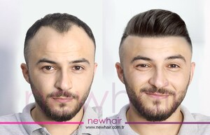 Image of New Hair Turkey Gallery 2