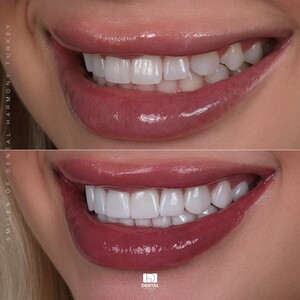 Image of Hollywood Smile