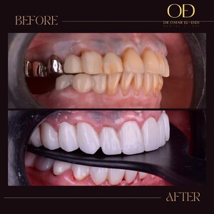 Image of Veneers - Dr. Omar El-Didi Dental Clinic