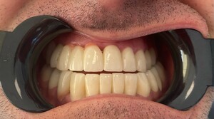 Image of Teeth whitening