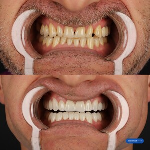 Image of Dental crowns