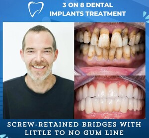 Image of Results of 3 on 8 Dental Implants 