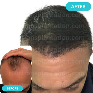 Image of Hairtransplantation.com Gallery 0