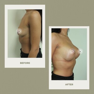 Image of Breast Implant - Dr. Zgaljardic Clinic