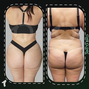 Image of BBL - Liposuction- One Clinic