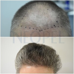 Image of Hair transplant