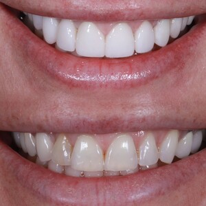 Image of Veneers