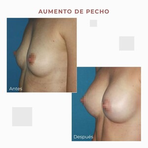 Image of Breast Implants