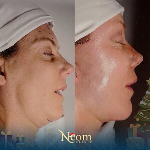 Image of Nose job - Neom Clinic