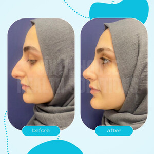 Image of 40th Day Control After Rhinoplasty Surgery - Sixth House Health Solutions