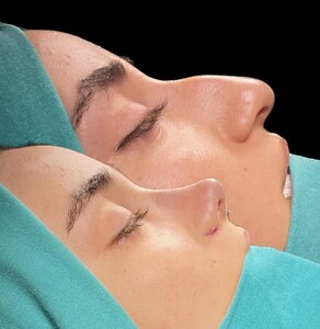 Image of Rhinoplasty - Dr Sedat Doğan