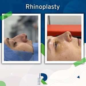 Image of Dr Remzi Fırıncıoğulları - rhinoplasty