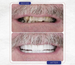 Image of Hollywood smile