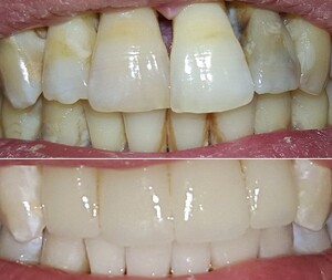 Image of Dental crowns