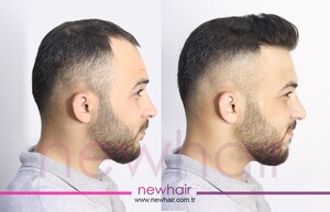 Image of New Hair Turkey Gallery 1