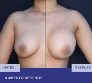 Image of Breast augmentation