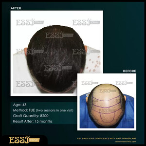 Image of Essi Hair Transplant Clinic Gallery 0