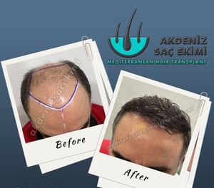 Image of Before and after hair transplantation