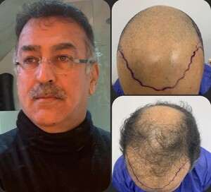 Image of Hair transplant - H2 Clinica