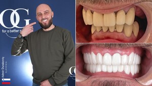 Image of Hollywood smile before and after